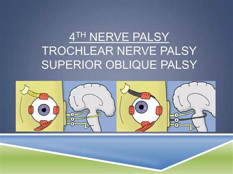 4th nerve palsy | PPTX