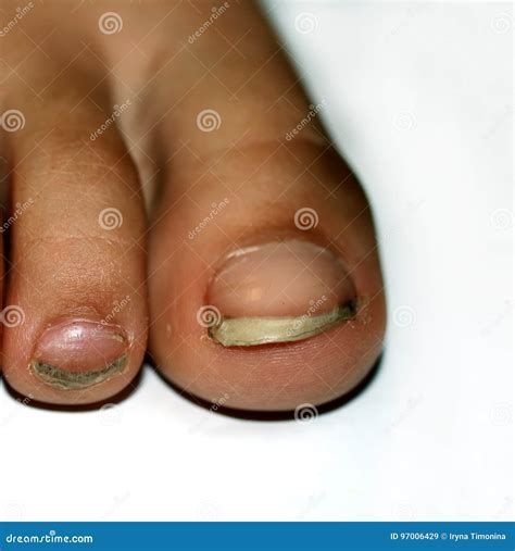 Nails on the Feet, Dirty. Ingrown Toenails. Black Dirty Fingernails. Stock Image - Image of ...
