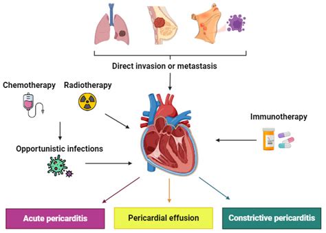 Pericardial Disease in Patients with Cancer: Clinical Insights on ...