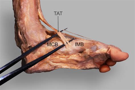 Tibialis Anterior Tendon Tear