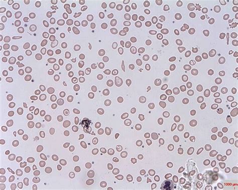 Diagnosis Thalassemia - Alomedika