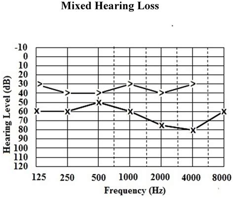 Classification of Hearing Loss | IntechOpen