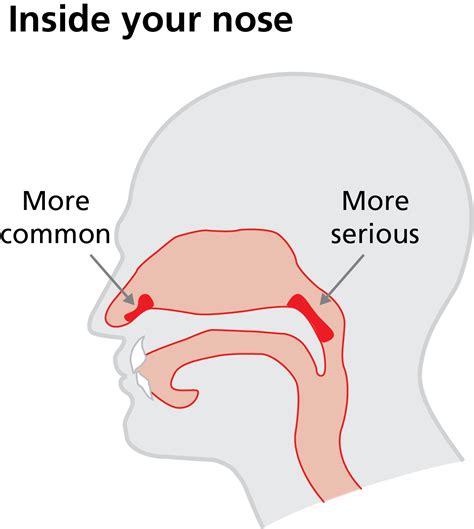 Epistaxis - Digital patient information hub