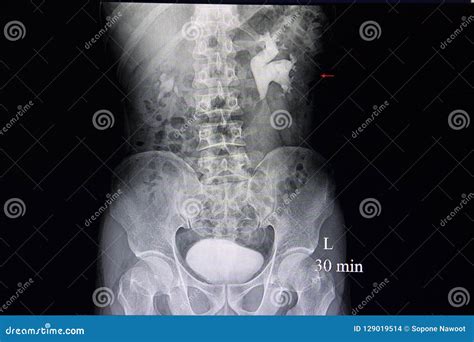 Hydronephrosis and Kidney Stones Stock Photo - Image of medicine ...