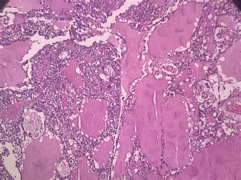 CLEAR CELL CARCINOMA OVARY – Histopathology.guru