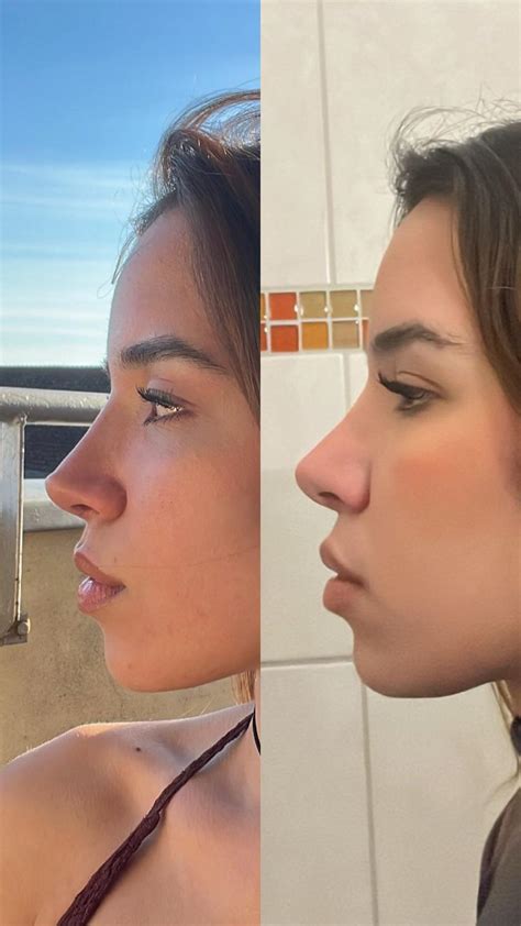 Less nose definition after eleven months post op : r/PlasticSurgery