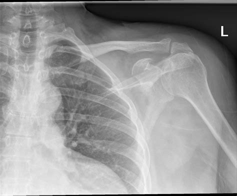 X Ray Normal Shoulder