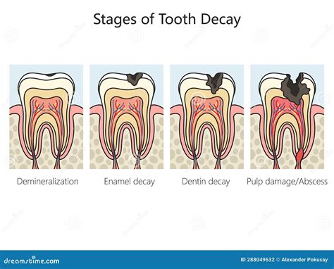 Tooth Decay Caries Stages Diagram Medical Science Stock Vector ...