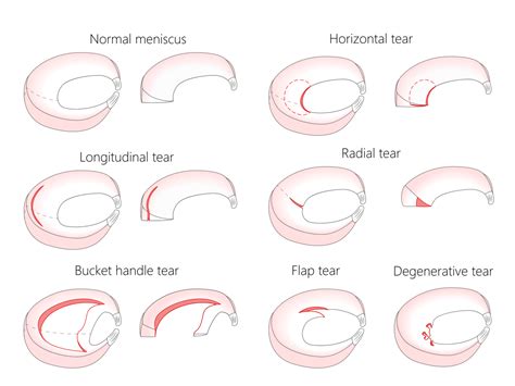 Meniscal Tear -Torn Meniscus - Knee Education
