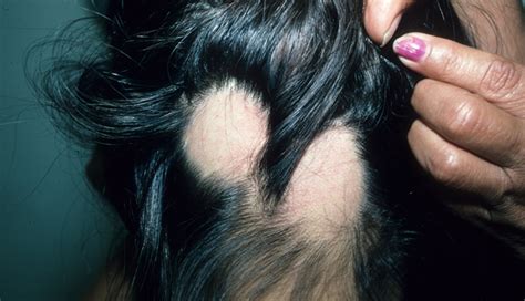 10 Home Remedies To Regrow Hair On Bald Patches - lifeberrys.com