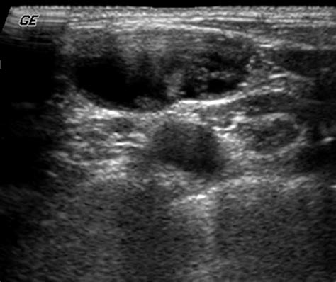 Groin Lymph Nodes Ultrasound