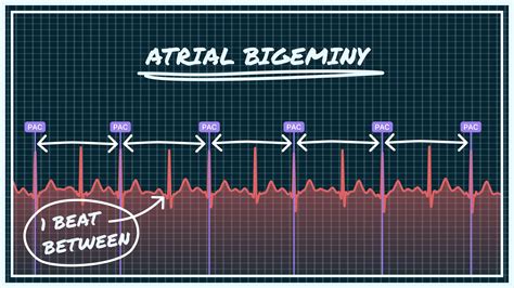 Atrial Bigeminy