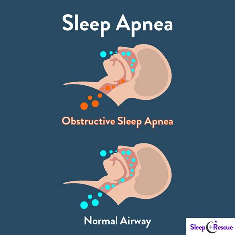 Image result for Sleep Apnea Example