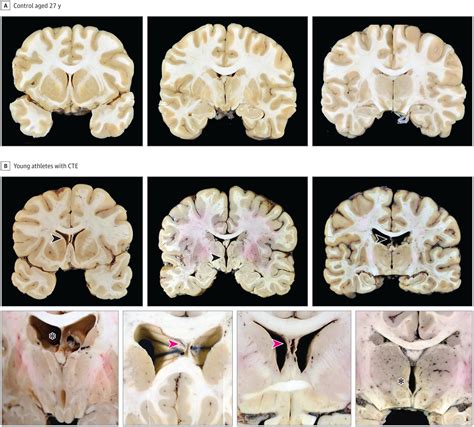 CTE Brain 的图像结果