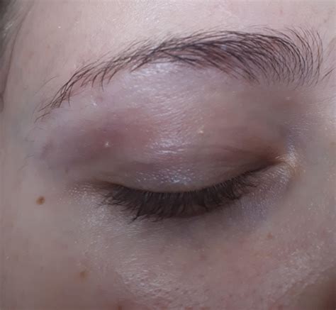 Small Bump On Eyelid