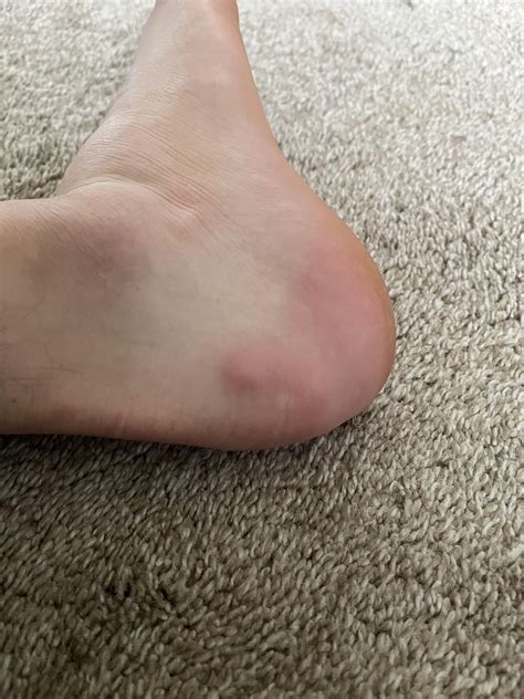 Hard Painless Lump on Back of Heel : r/medical_advice