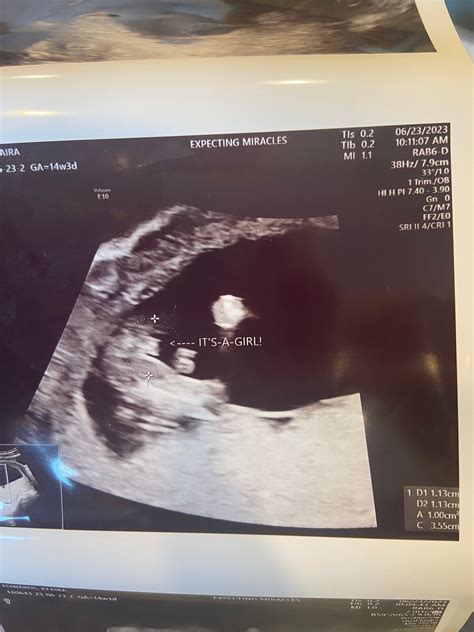 14 week ultrasound | BabyCenter