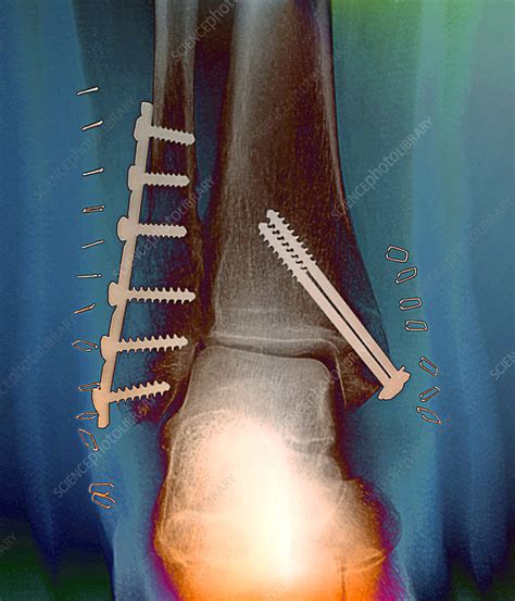 Pinned ankle fractures, X-ray - Stock Image - M330/1371 - Science Photo ...