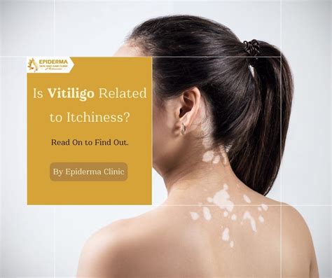Vitiligo and Itchiness | Best Dermatologists in Bangalore | Epiderma Clinic