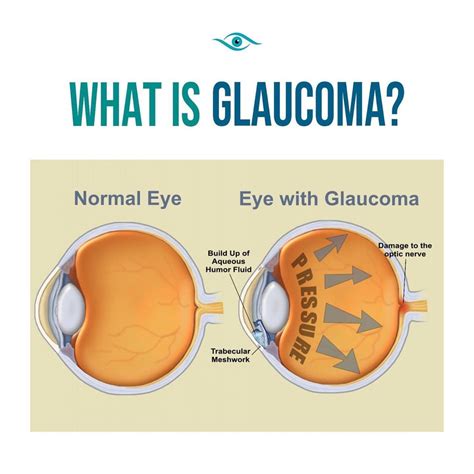 Glaucoma is a disease of the eye in which fluid pressure within the eye rises – if left ...
