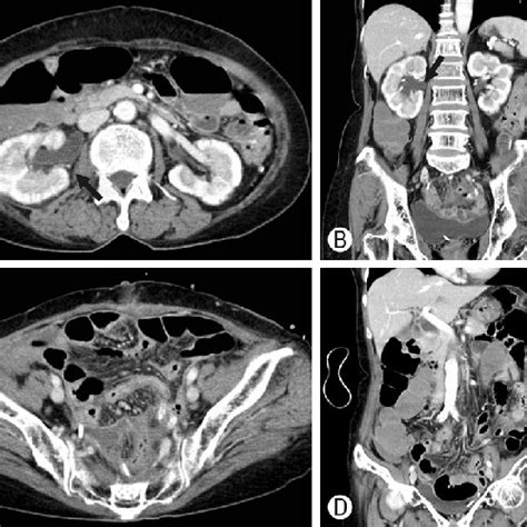 Image result for Colonic Diverticulum CT