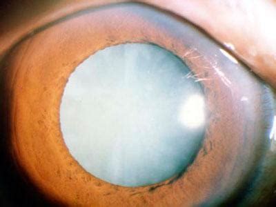 视网膜母细胞瘤，如何才能尽早发现？| 果壳 科技有意思