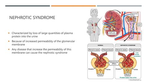 Acute glomerulonephritis and nephrotic syndrome.pptx