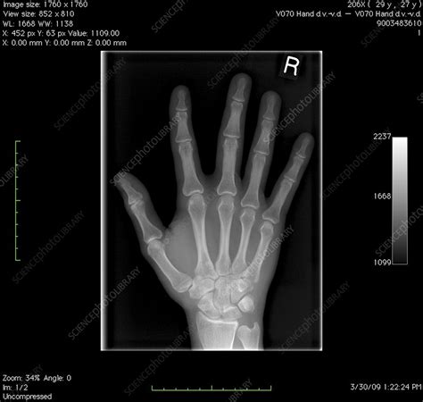 Normal Hand X Ray