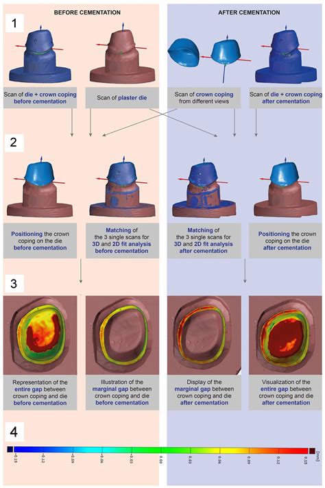 Effect of Luting Materials on the Accuracy of Fit of Zirconia Copings ...