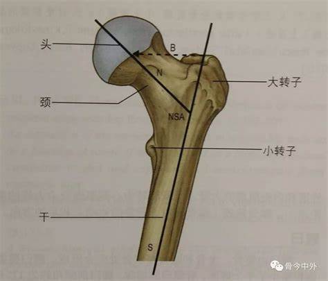股骨大转子骨折示意图