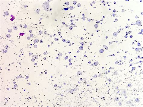 Thyroglossal Duct Cyst Cytology