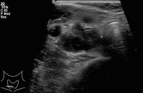 Parathyroid Tumor Ultrasound