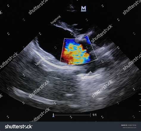 11 Echocardiogram Heart Failure Stock Photos, Images & Photography ...