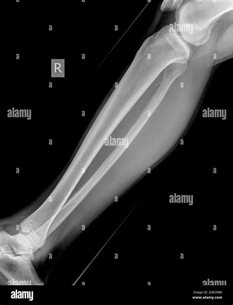 Xray of leg ? tibia fibula broken Black and White Stock Photos & Images - Alamy