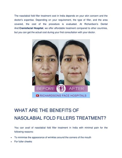PPT - 5 Things to Know About Nasolabial Fold Filler Treatment in India PowerPoint Presentation ...