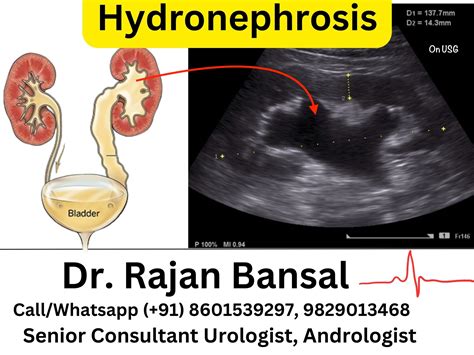 Hydronephrosis