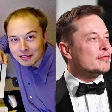 Hair Loss and Hair Transplant Advice - Matt Dominance