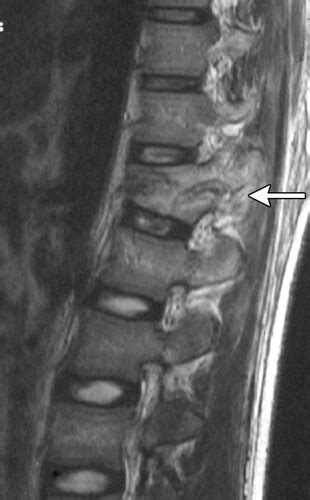 Image result for Flexion-Distraction vs Decompression