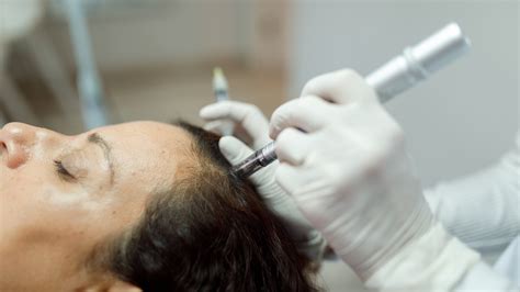 Unlocking the Secrets of Hair Regrowth: The Miraculous Benefits of Microneedling - Cellustrious