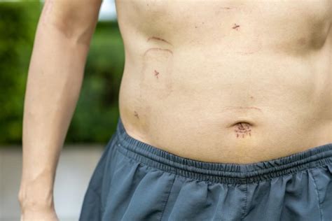 Image result for Appendix Exploded