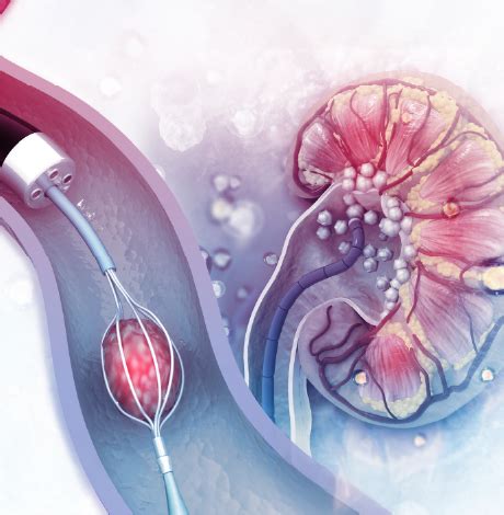 Image result for Nephrectomy Procedure