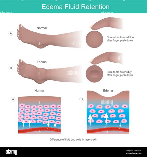 Peripheral edema hi-res stock photography and images - Alamy