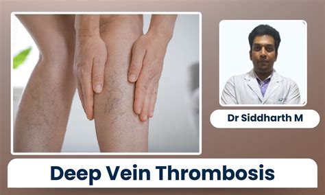 Deep Vein Thrombosis during Flights: Why It’s a Growing Concern in ...