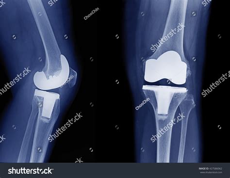 Knee Replacement Xray