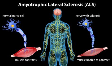 Daily Aids for People with ALS (Lou Gehrig’s Disease) | Performance Health