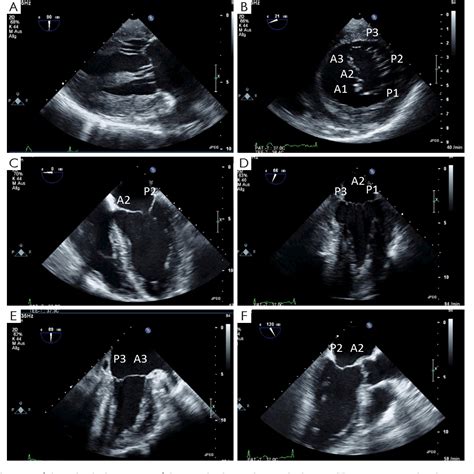 Transesophageal Echocardiogram 4 Chamber