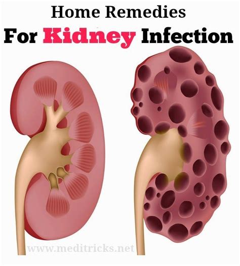 kidney infection treatment
