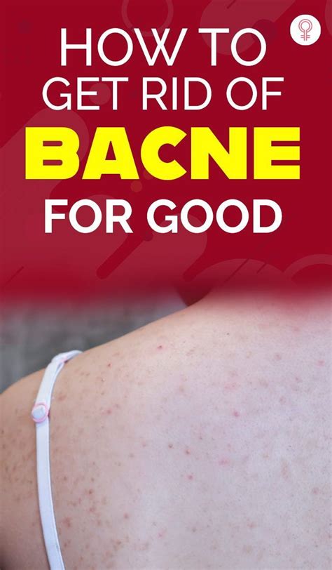 Exploding Bacne 的图像结果