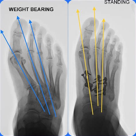 Foot Orthotics For Metatarsus Adductus at Lilian Dixson blog