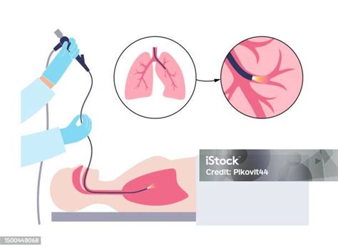 Bronchoscopy Procedure Concept向量圖形及更多插圖圖片 - 插圖, Pulmonologist, 人 - iStock